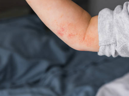 What to Expect: Treatments and Care for Autoimmune Conditions