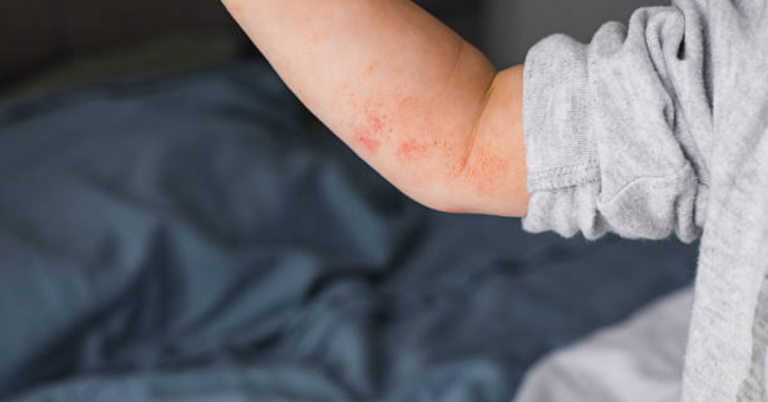 What to Expect: Treatments and Care for Autoimmune Conditions
